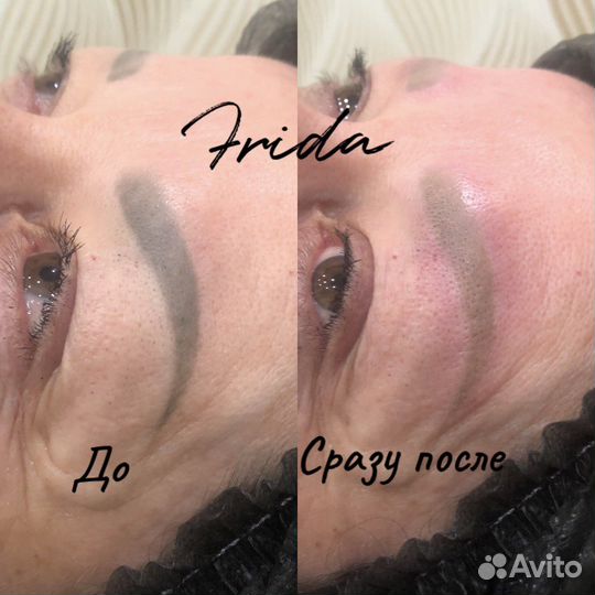 Лазерное удаление татуажа и татуировок