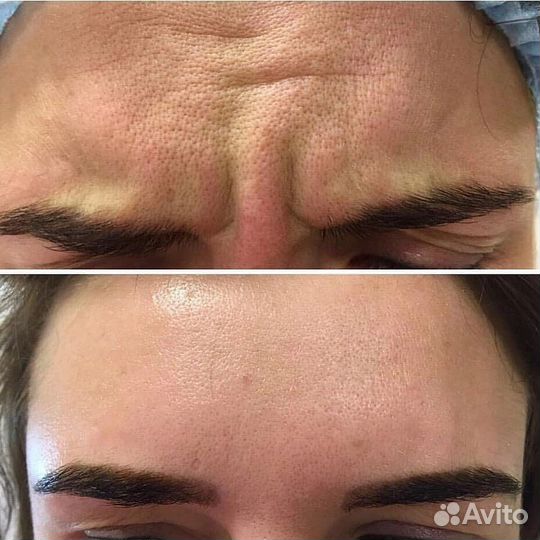 Ботулинотерапия