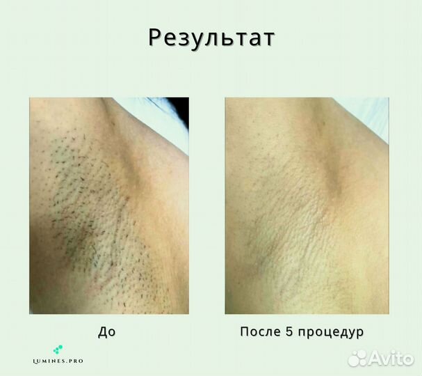 Диодный лазер Lumines’ Max Plus 2000