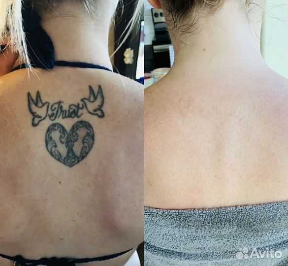 Удаление тату и татуажа на современном лазере