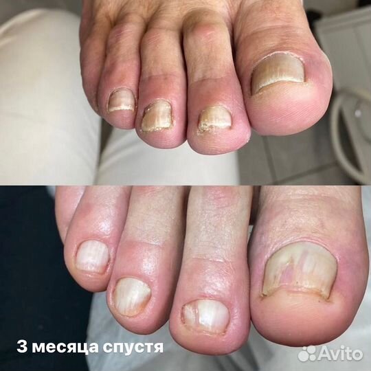 Лечебный педикюр