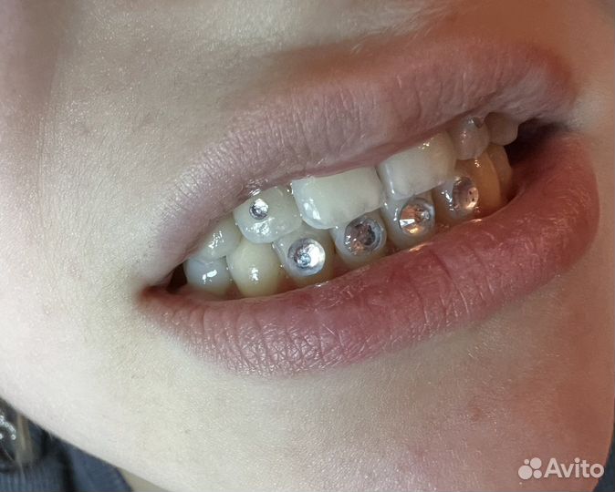 Установка скайсов