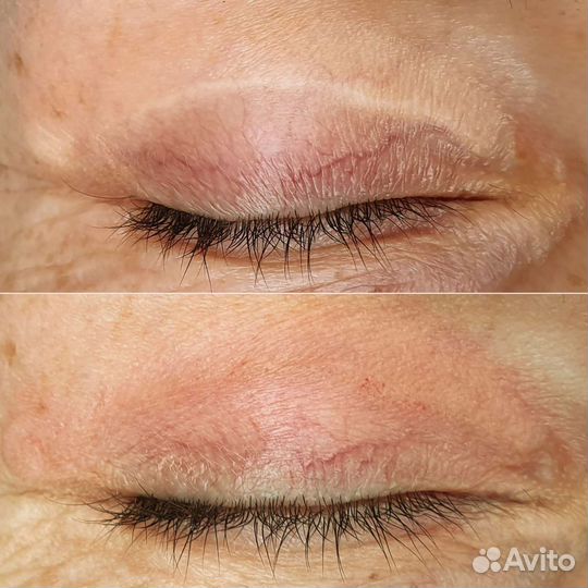 Камуфляж шрамов, ореол. Перекрытие татуажа