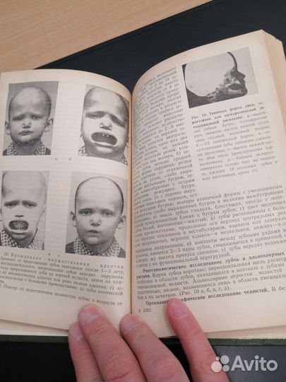 Профилактика зубочелюстных аномалия. хорошилкина