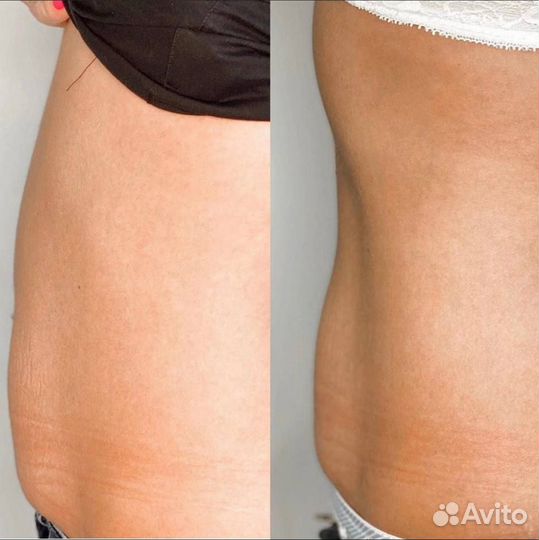 Удаление жировых отложений инъекционная процедура
