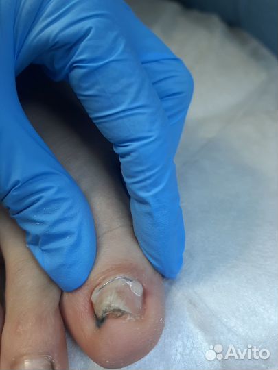 Педикюр/коррекция вросшего ногтя/нить