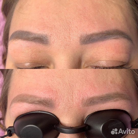 Удаление татуажа лазером