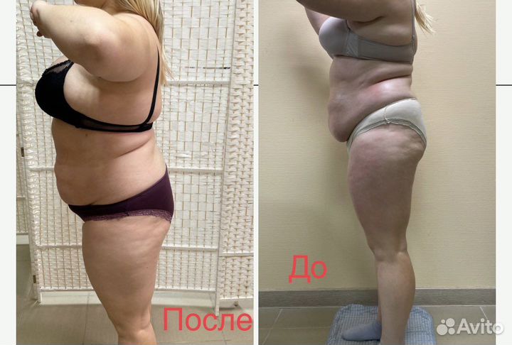 Аппаратный +Вакуумный массаж + RF-лифтинг