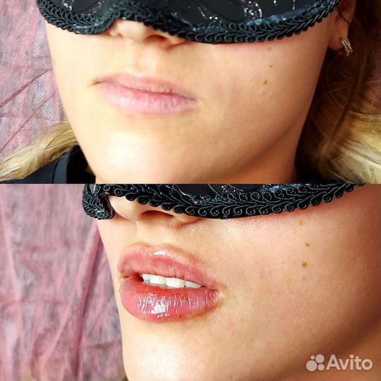 Биоревитализация