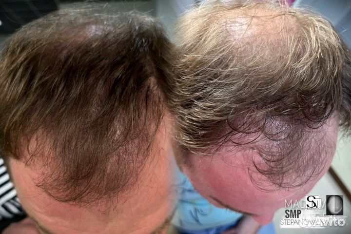 Трихопигментация SMP