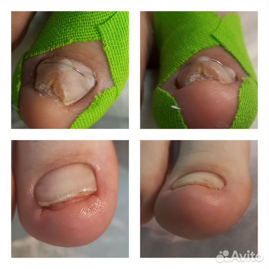 Подолог(сложные ноги,трещины,вросший но