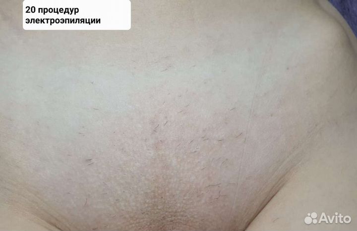 Электроэпиляция