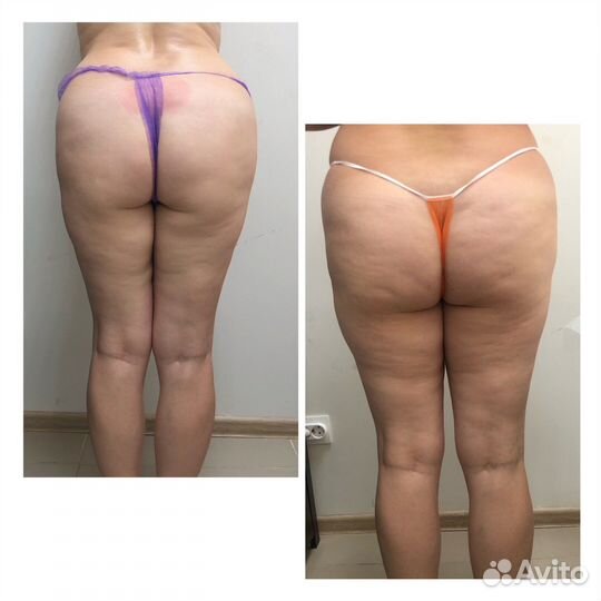 Массаж антицеллюлитный,лимфодренажный,буккальный