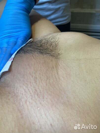 Шугаринг депиляция сахар и воск