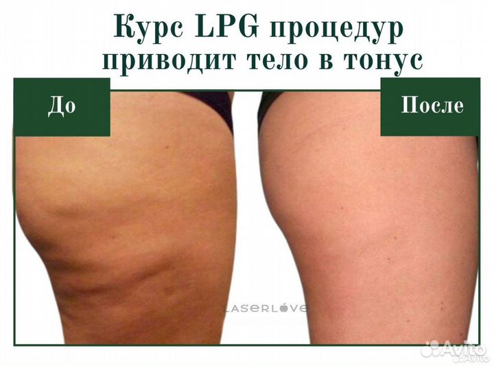 Аппаратный LPG массаж