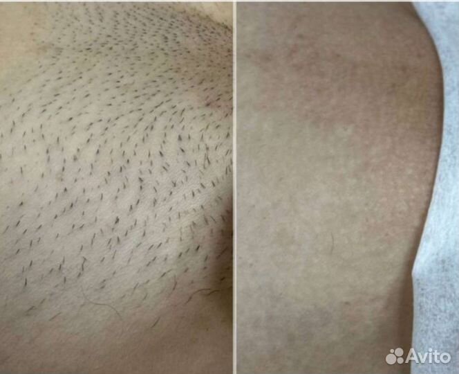 Фотоэпиляция
