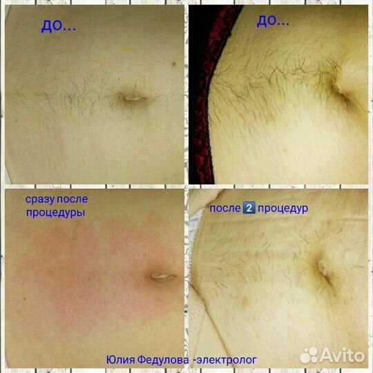 Электроэпиляция /Шугаринг/ Восковая депиляция