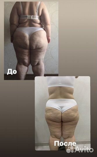 Криолиполиз