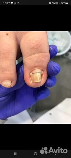 Коррекция вросшего ногтя