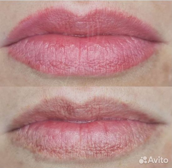 Удаление татуажа