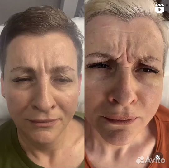 Ботокс (ботулинотерапия)