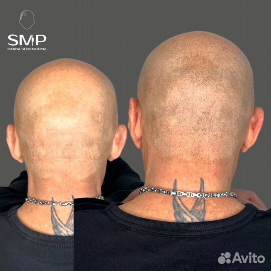 Мужская трихопигментация