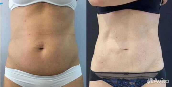 Стройное тело, упругость кожи, лифтинг на индиба