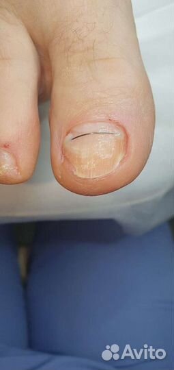 Медицинский педикюр подолог