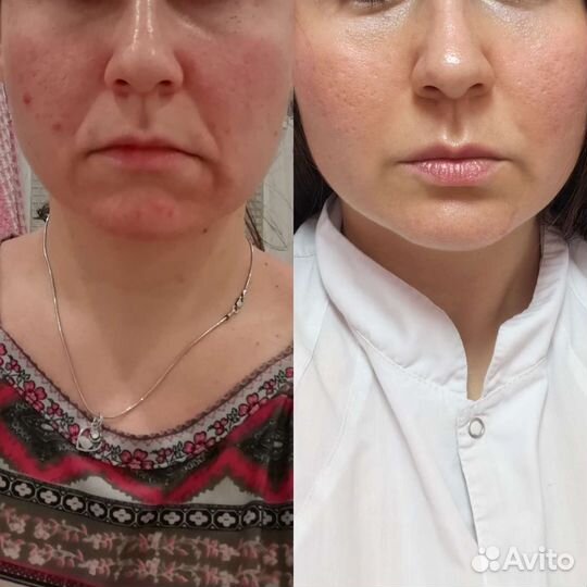 Массаж лица / Миофасциальный массаж / Старвак Styx