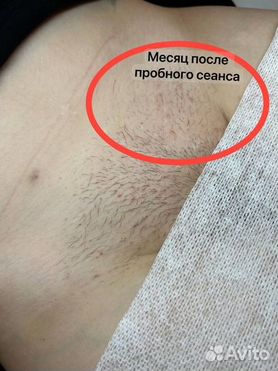 Электроэпиляция