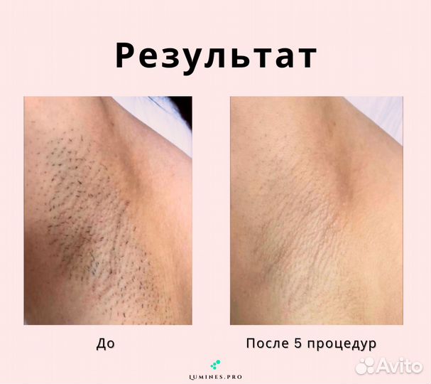 Аппарат для эпиляции Лю’минес Макс’Ван 1200вт