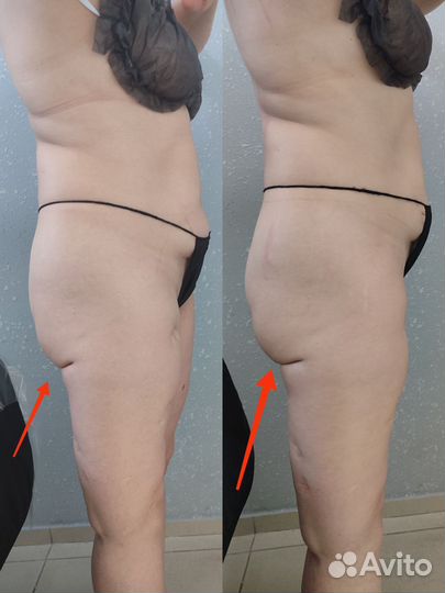 Карамельная липосакция модели