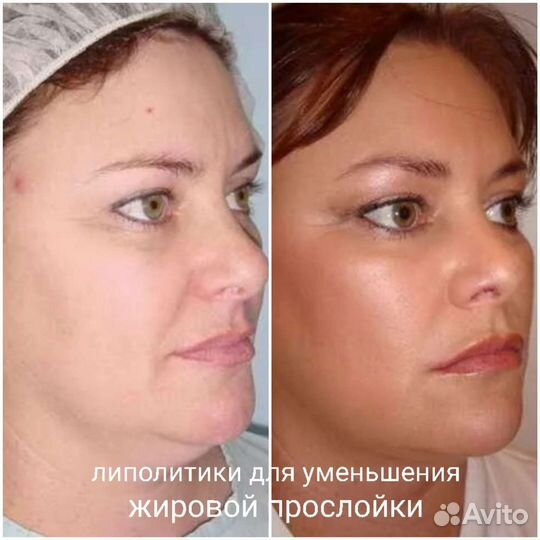 Инъекции ботокса в лоб