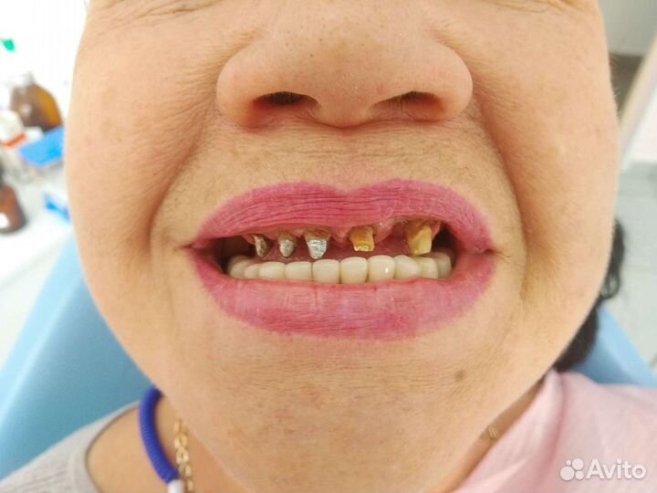 Съёмные протезы, несъёмные. Зубной техник