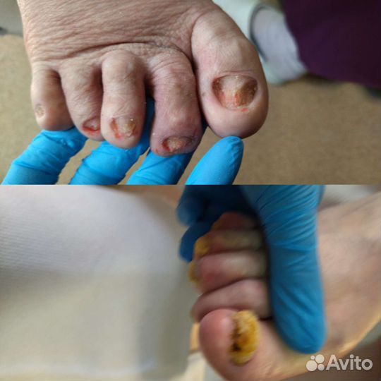 Медицинский педикюр подолог. Выезд на дом