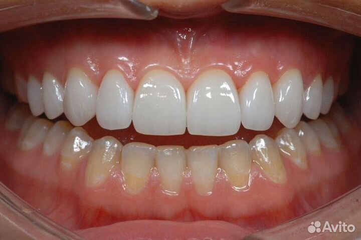 Керамические конструкции IPS е.мах