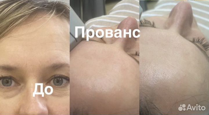 Модели на СМАС лифтинг