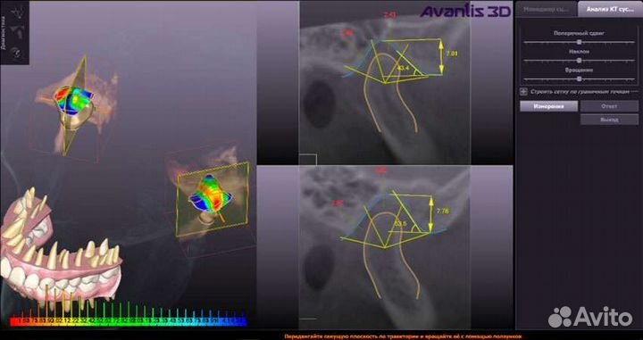 Программа для стоматологов Avantis 3D