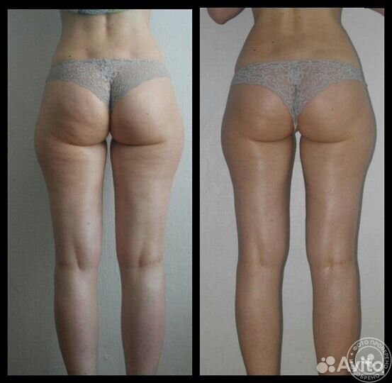 Общий массаж всего тела, антицеллюлитный массаж