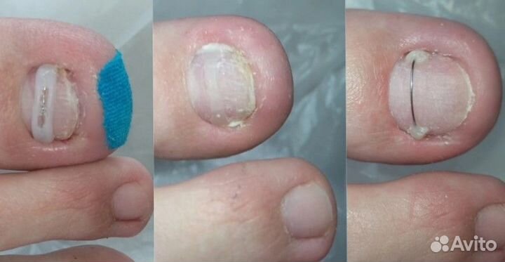 Педикюр от подолога