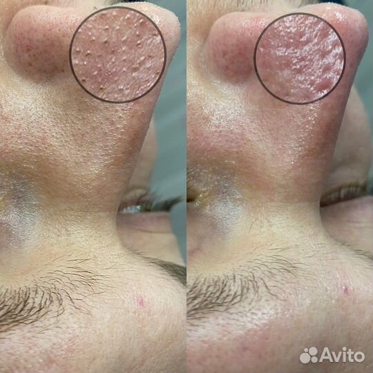 Чистка лица