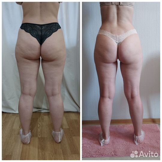 Массаж, антицеллюлитный массаж