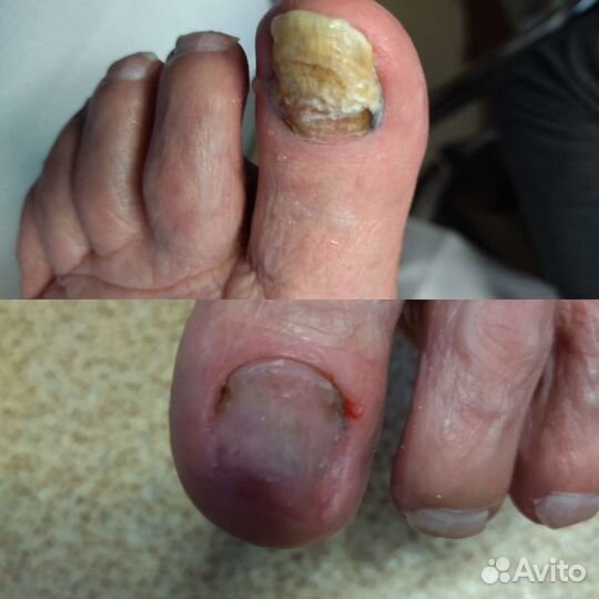 Медицинский педикюр подолог. Выезд на дом