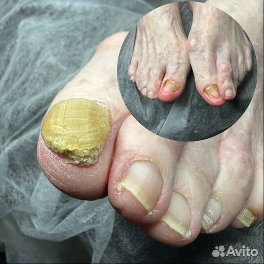 Услуги подолога/ выезд на дом