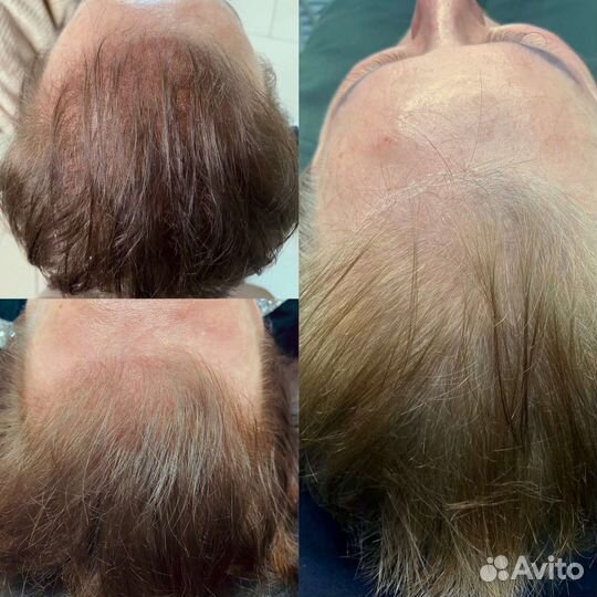 Трихопигментация головы