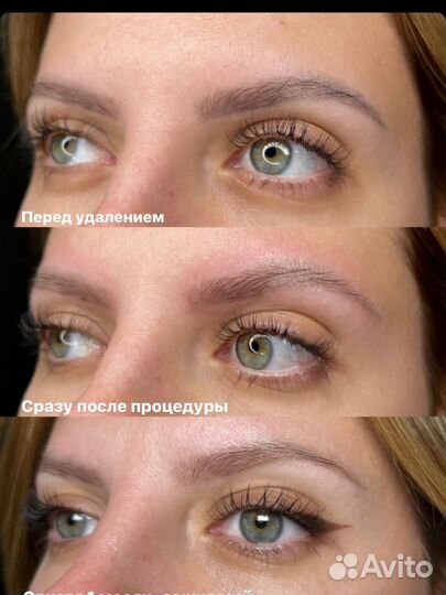 Удаление татуажа лазером