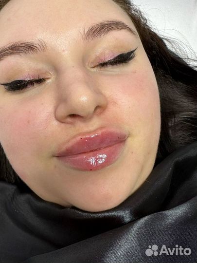 Контурная пластика губ