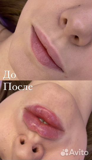 Косметолог. Ботокс. Контурная пластика