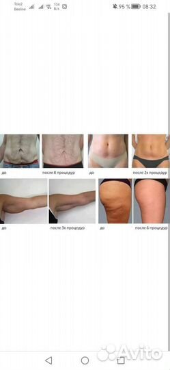 Ультразвуковая кавитация, RF лифтинг