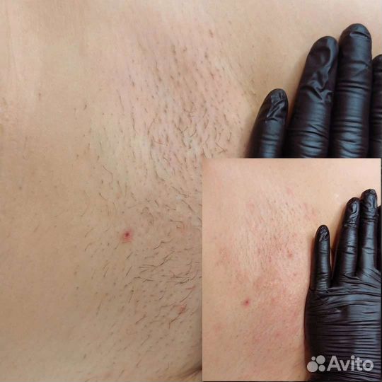 Шугаринг: глубокое бикини